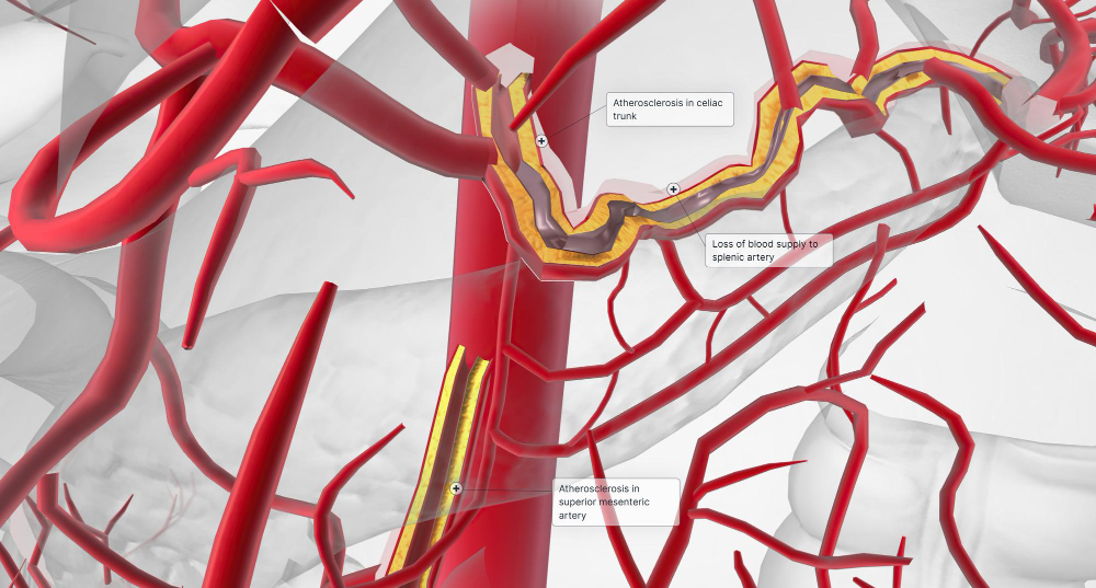 Coronary Angiography