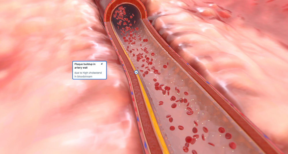 Coronary Angioplasty