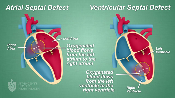 Key-Hole Method Of Closing Hole In The Heart