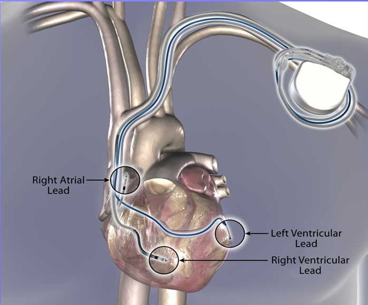 Cardiac Re-Synchronisation Therapy (CRT)