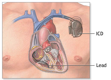 Implantable Defibrillators (ICD)